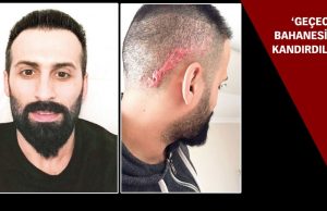 Saç ekimi istedi…keloid…
