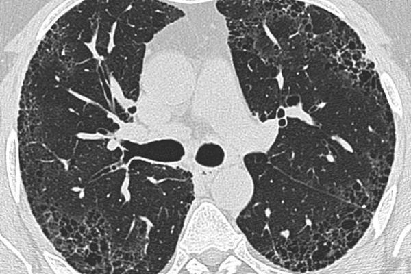 İdiopatik Pulmoner Fibrozis