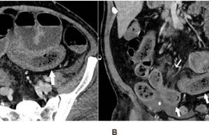 COVID-19’lu hastalarda gastrointestinal ve karaciğer tutulumunun prognozu üzerine meta-analiz