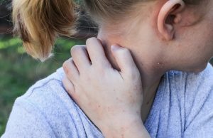 Seboreik Dermatit: Epitel Bariyer Hastalıklarıyla Geniş Çaplı Örtüşmeyi Ortaya Koydu