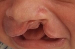Ortodontistlerin paylaşımları dudak ve damak yarığı olan genç ve çocuklara destek olacak