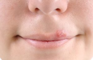 Herpes simpleks virüsünü ne tetikliyor?