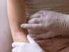Atopik Dermatit Kimlerde Görülür?