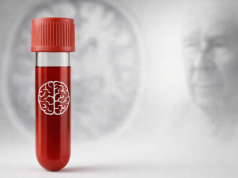 AB Roche’un Alzheimer Kan Testini Onayladı: Erken Teşhiste Yeni Dönem