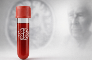 AB Roche’un Alzheimer Kan Testini Onayladı: Erken Teşhiste Yeni Dönem